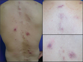First Case of Folliculitis Associated with Granuloma as a Complication of Bee Sting Acupuncture