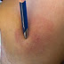 Using Bee Venom for Healing Purposes (Video)