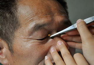 Bee Sting Therapy Causing a Buzz in China